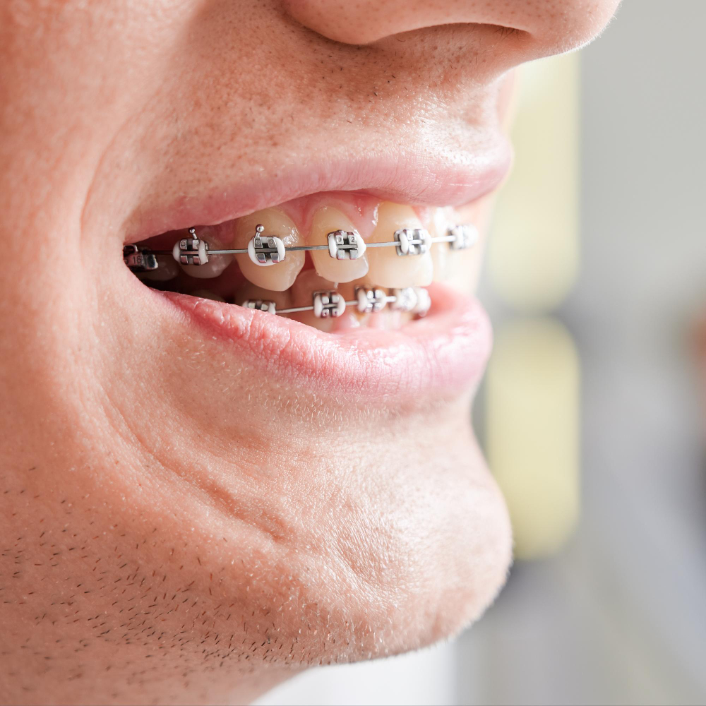 1903 Ortodoncia con Brackets - 3