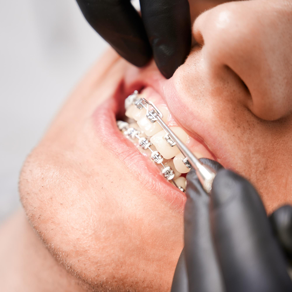 2611 Ortodoncia con Brackets - 2