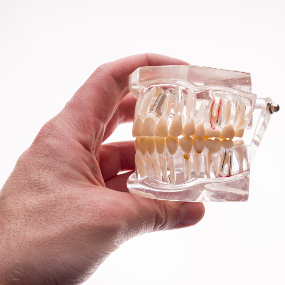 4266 Implantes dentales - 5