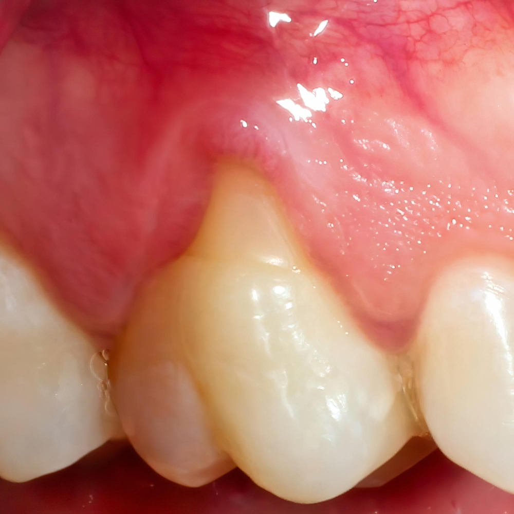 43927 Periodontitis - 2