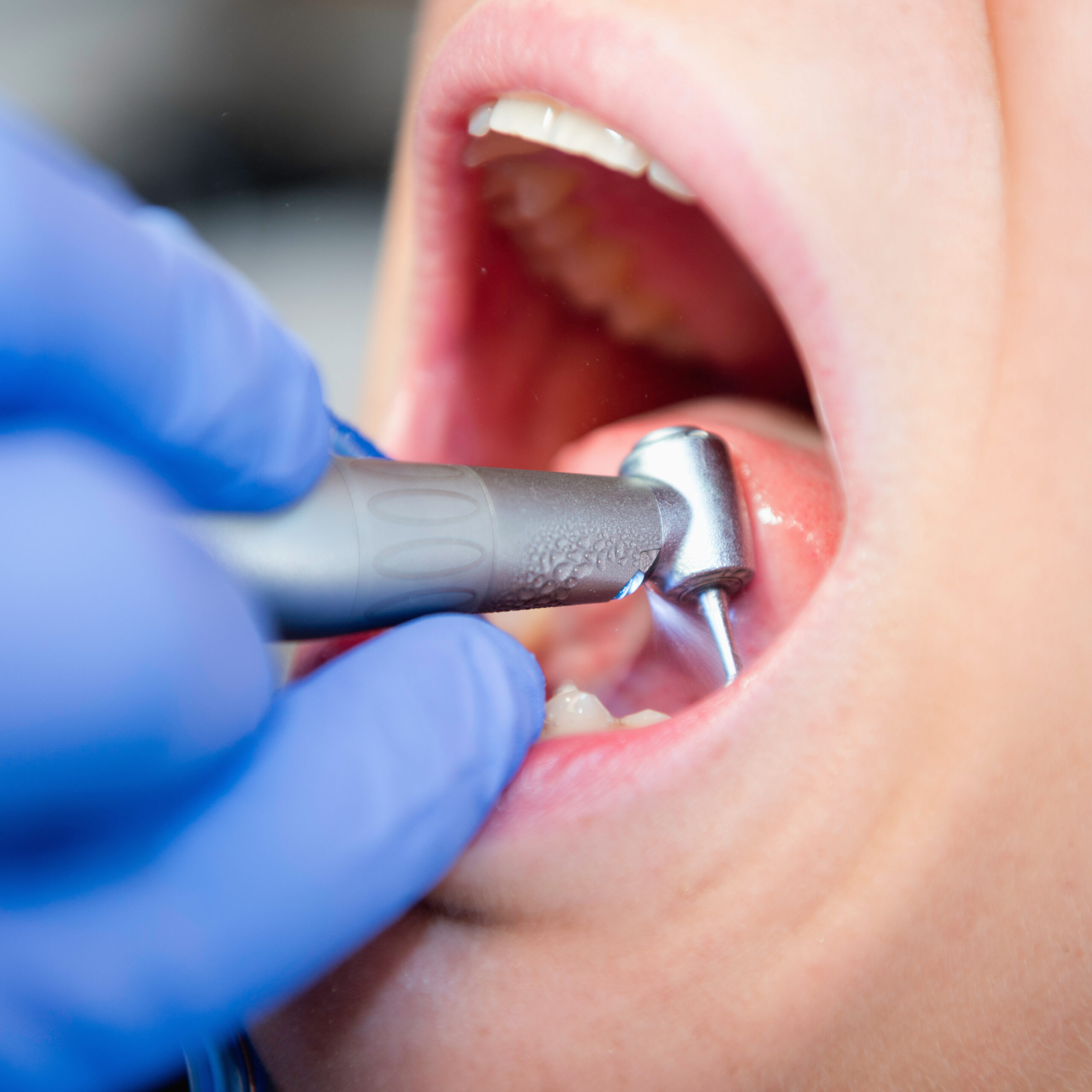 Dental drill close-up Blanqueamiento - 4